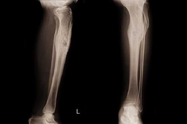 Read more about the article Osteomielitis: Penyebab, Gejala, dan Pengobatan