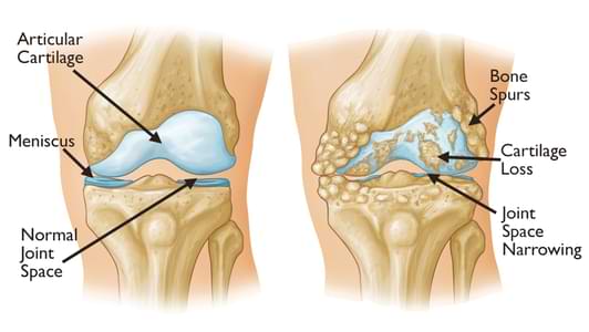 Read more about the article Osteoarthritis: Penyebab, Gejala, dan Pengobatan