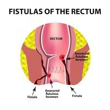 Read more about the article Fistula Ani: Penyebab, Gejala, Diagnosis, Pengobatan, dan Pencegahan