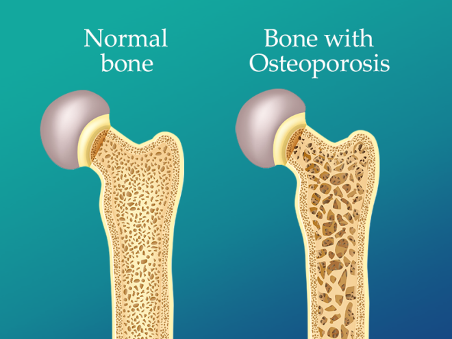 Read more about the article Osteoporosis: Penyakit Tulang Rapuh yang Perlu Diketahui